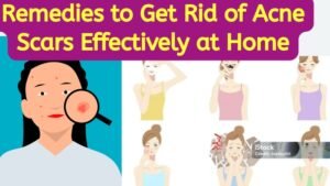 Remedies to Get Rid of Acne Scars Effectively at Home