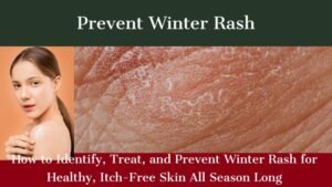 Prevent Winter Rash